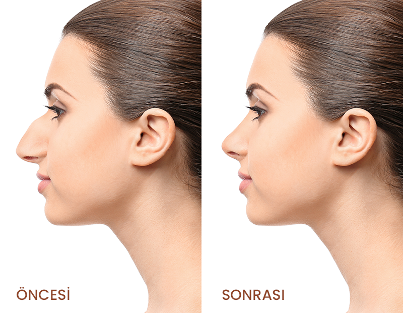 Nose Surgery