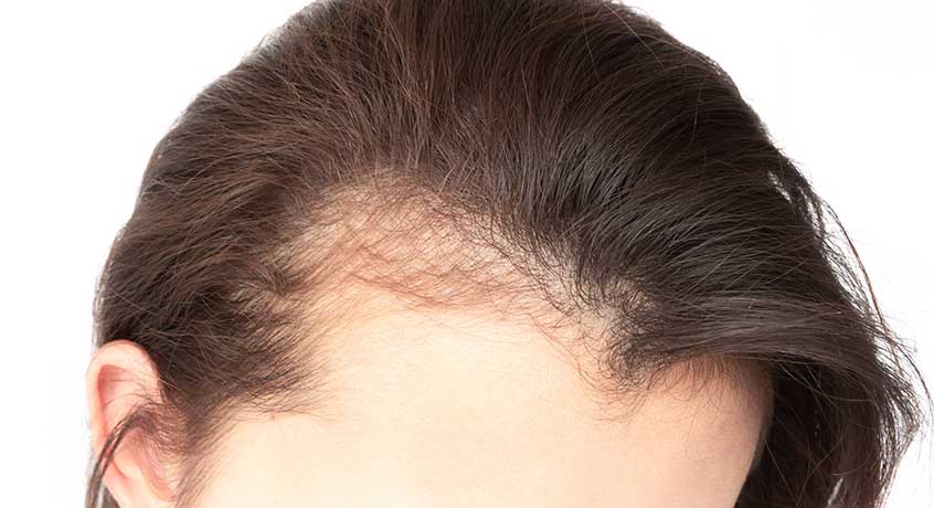 Women’s Hair Transplant