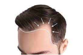 Unshaven Hair Transplant